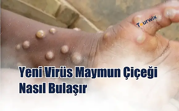 Maymun Çiçeği Nasıl Bulaşır? Tüm Detaylar ve Uzman Görüşleri